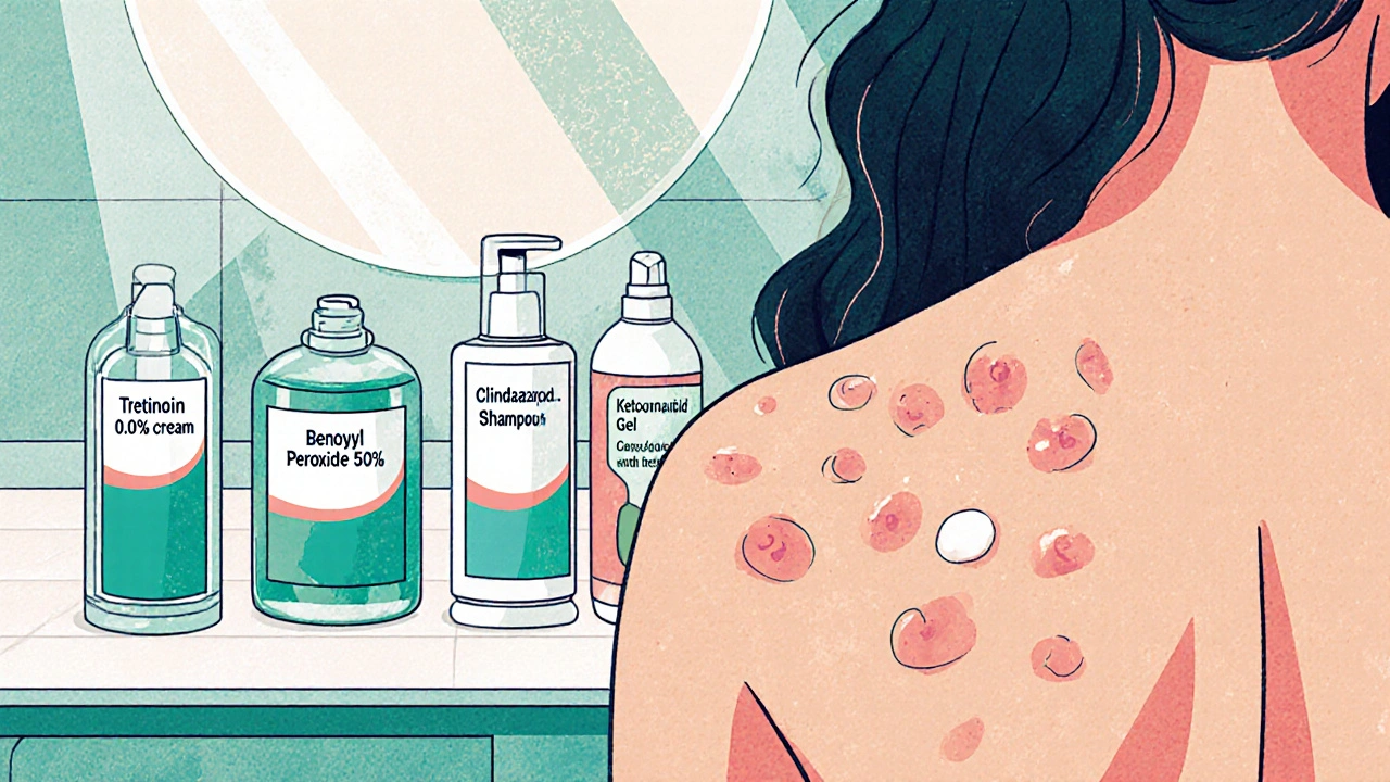 Bathroom shelf with acne treatment products and close‑up of back lesions being treated.